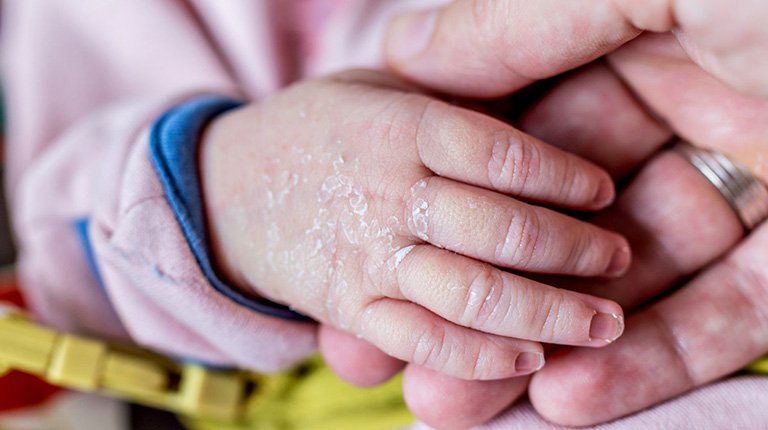 Bé 11 tháng tuổi bị khô da sần sùi lâu ngày phải điều trị như thế nào?