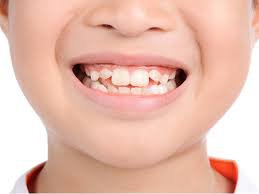 Trẻ từ 5-7 tuổi răng cửa giữa vĩnh viễn mọc