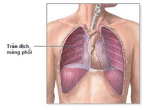 Điều trị tràn dịch màng phổi do nhiễm khuẩn có cần nằm viện suốt thời gian điều trị không?