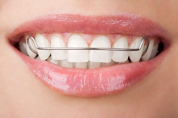 Mang khay duy trì sau tháo niềng răng nhưng không phủ hết các răng trong cùng có sao không?