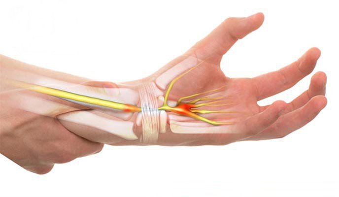 Cổ tay bị nhức sau khi điều trị trật cổ tay 2 năm khắc phục thế nào?