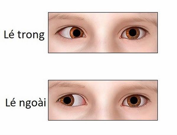 Lác mắt kèm rung giật nhãn cầu có điều trị được không?