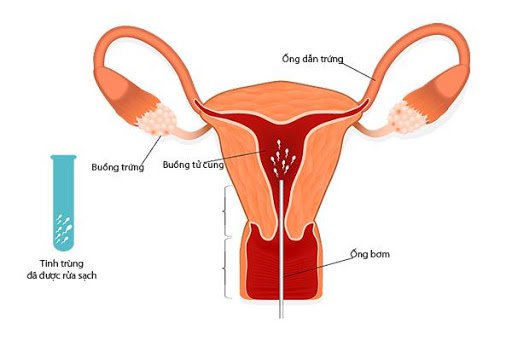 Tỉ lệ tinh trùng sống 36% có nên bơm tinh trùng vào buồng trứng không?