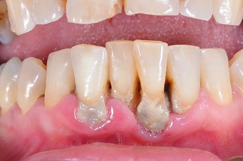 Răng bị lung lay kèm ăn mòn sau khi trám có tồn tại được không?