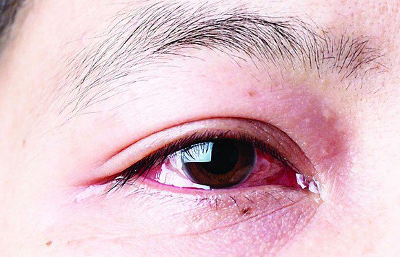 Mẩn đỏ kèm đỏ mắt sau sốt khi mang thai 4 tháng có sao không?