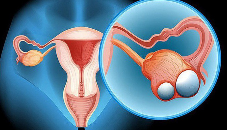 Nang buồng trứng phải xuất huyết sau phẫu thuật cắt tử cung 12 ngày có sao không?
