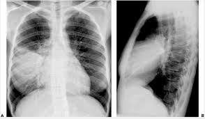 Viêm phổi thùy ở trẻ em