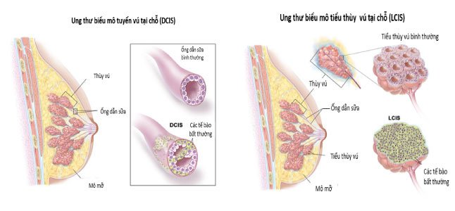 ung thư biểu mô ống tại chỗ và ung thư biểu mô tiểu thùy tại chỗ