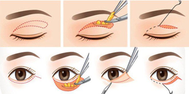 Phẫu thuật điều trị co giật mí mắt sau bóc mỡ mắt có được không?