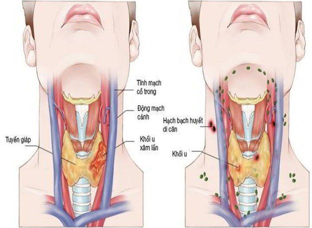 Ung thư vòm họng tái phát điều trị thế nào?