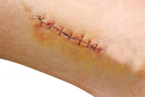 Vết khâu ở chân đã cắt chỉ 2 tuần vẫn tím kèm đỏ máu có sao không?