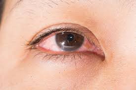 Mắt hay viêm kèm yếu lại sau thay giác mạc phải làm sao?