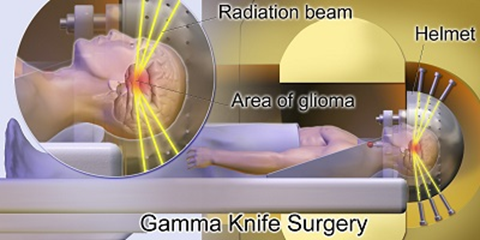 Phẫu thuật dị dạng mạch máu não bằng dao Gamma có hiệu quả không?
