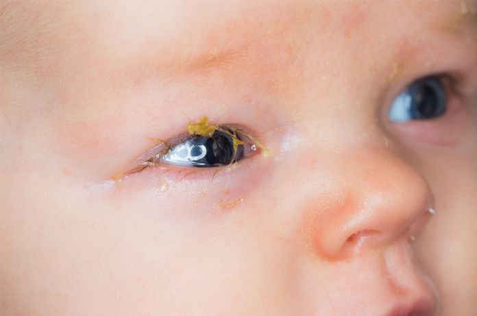 Trẻ 2 tháng tuổi bị viêm kết mạc điều trị như nào?