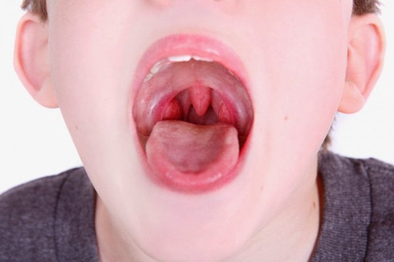 Nguyên nhân trẻ 8 tuổi hay bị ho, viêm amidan tái lại nhiều lần?