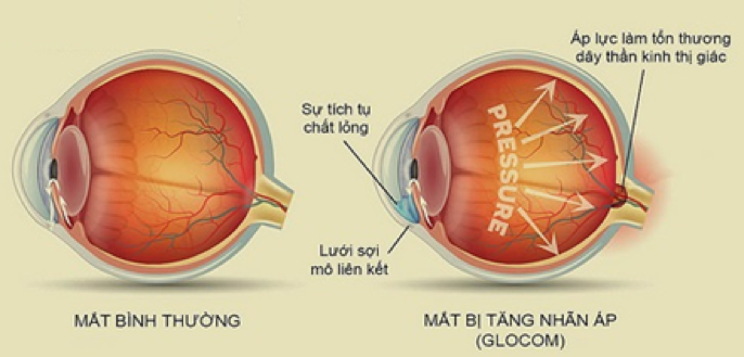 Chấn thương thị thần kinh mắt làm mắt mờ không thấy rõ chữa trị được không?