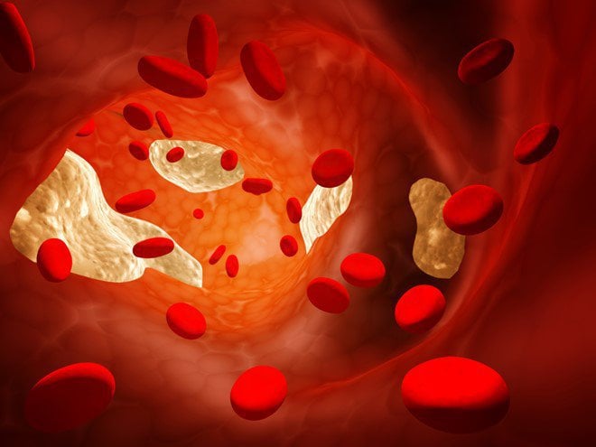 Tăng cholesterol trong máu