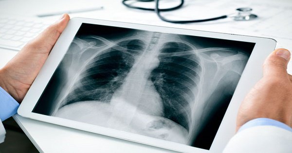 Kết quả X quang phổi bất thường