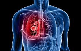 Có đốm đen trong phổi có nguy hiểm không?