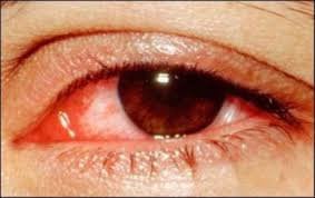 Thỉnh thoảng ngứa mi mắt sau điều trị viêm bờ mi phải làm thế nào?
