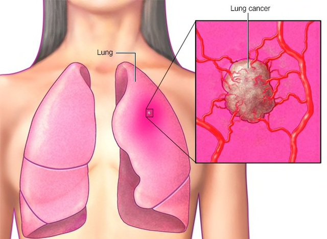 Ung thư phổi sống được bao lâu