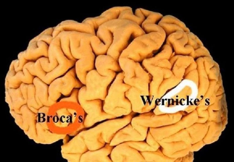 Tìm hiểu về bệnh não Wernicke