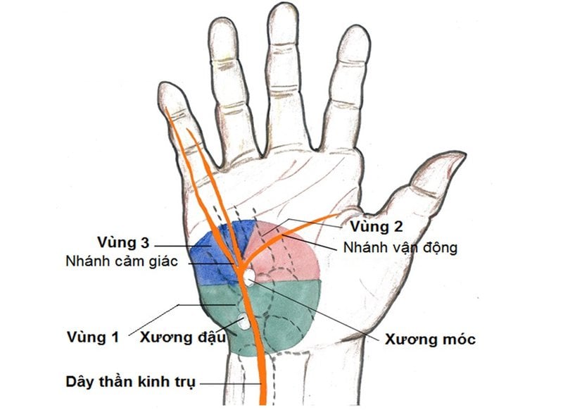 Tổn thương dây thần kinh trụ hơn 1 năm teo cơ bàn tay trái điều trị thế nào?