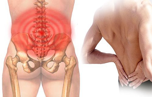 Đau lưng vùng hông do thừa xương ở đốt sống là dấu hiệu bệnh gì?