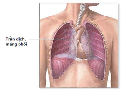 Lao phổi kèm tràn dịch màng phổi sử dụng thuốc lá điện tử được không?