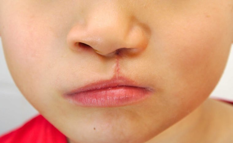 Phẫu thuật đóng khe hở môi lần 1 mũi trẻ không cân có thể phẫu thuật lần 2 khi nào?