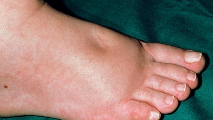 Vết rách mu bàn chân chảy nước vàng, đau tấy kèm sưng phù sau khâu điều trị thế nào?