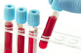 Xét nghiệm máu kết quả WBC 8200, Amy: 13 là sao?