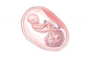 Hình ảnh minh họa khối u quái vùng cùng cụt thai nhi.