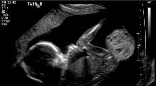 Hình ảnh siêu âm khối u quái vùng cùng cụt thai nhi.