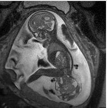 Hình ảnh cộng hưởng từ khối u vùng cùng cụt thai nhi.