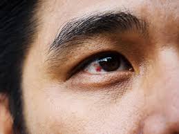 Máu bầm ở mắt có nguy hiểm không?