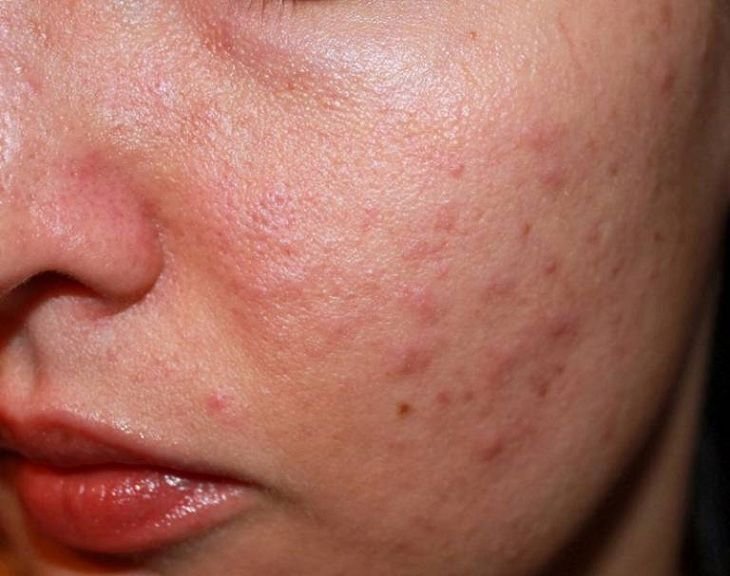 Da dễ bị ngứa kèm nổi mẩn đỏ vùng mũi, trán thuộc vùng da nào và chăm sóc thế nào?