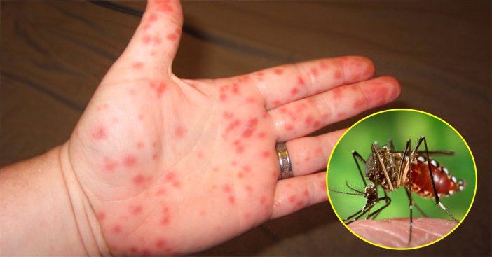 Sốt xuất huyết Dengue thì có nên điều trị tại nhà không?