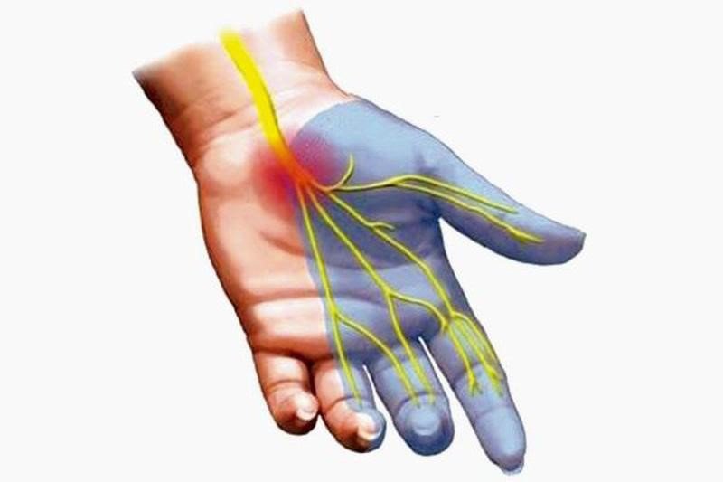 Dây thần kinh giữa ở lòng bàn tay bị đứt 15 năm có phục hồi lại như trước không?