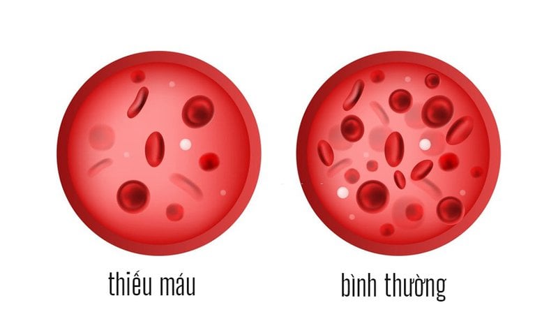 4 loại thiếu máu thường gặp