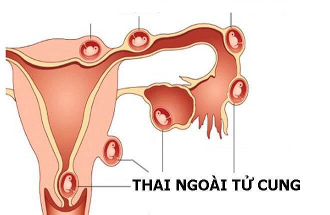 Thai 3 tuần có dấu hiệu thai ngoài tử cung có dùng thuốc được không?