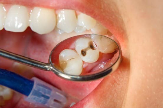 Sâu răng gây đau nhức có nhổ được không?