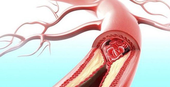 Phương pháp siêu âm IVUS có đánh giá được nguy cơ hẹp mạch vành không?