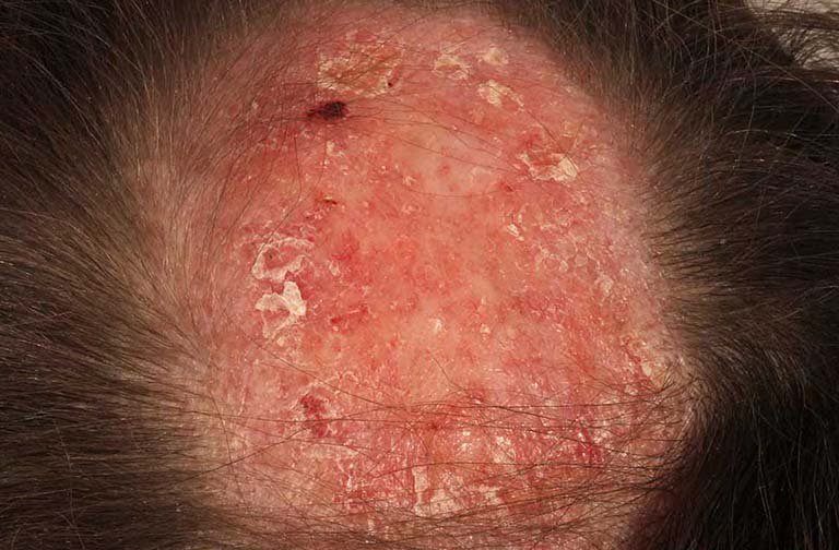 Hình ảnh người bệnh bị rụng tóc có sẹo do bệnh lupus đỏ