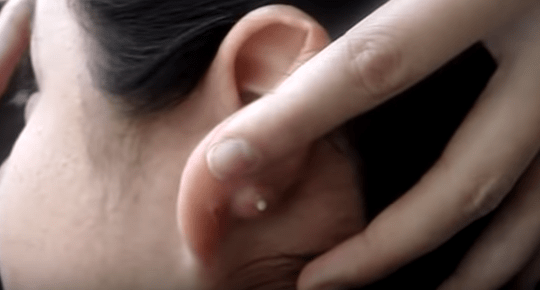 Tai sưng cục sau khi bấm lỗ tai hơn 3 tuần có sao không?