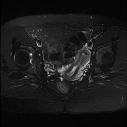 Hình tử cung một sừng trên MRI