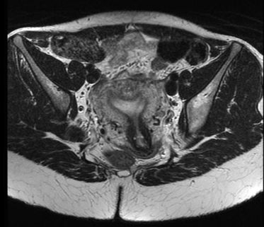 Hình ảnh tử cung hình cung trên phim MRI