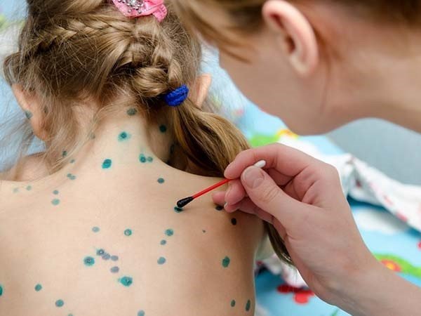 Nguyên nhân và cách điều trị trẻ 7 tuổi sốt thủy đậu cao kéo dài?