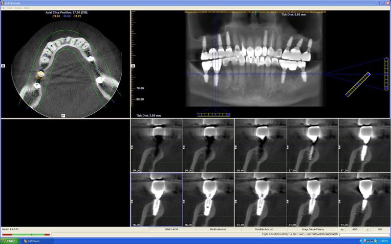chụp X quang Cone beam CT