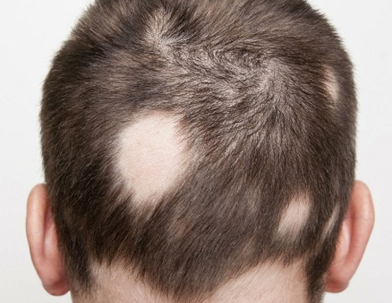 Các nguyên nhân gây rụng tóc từng mảng (alopecia areata)